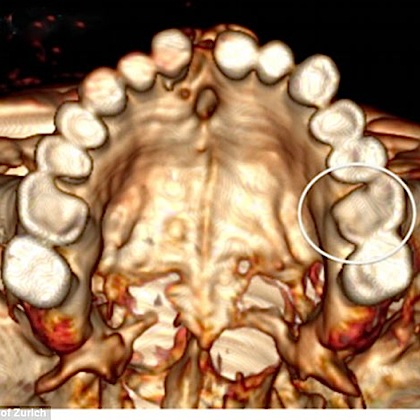 трехмерная томография зубов ледяного человека Отци.jpg